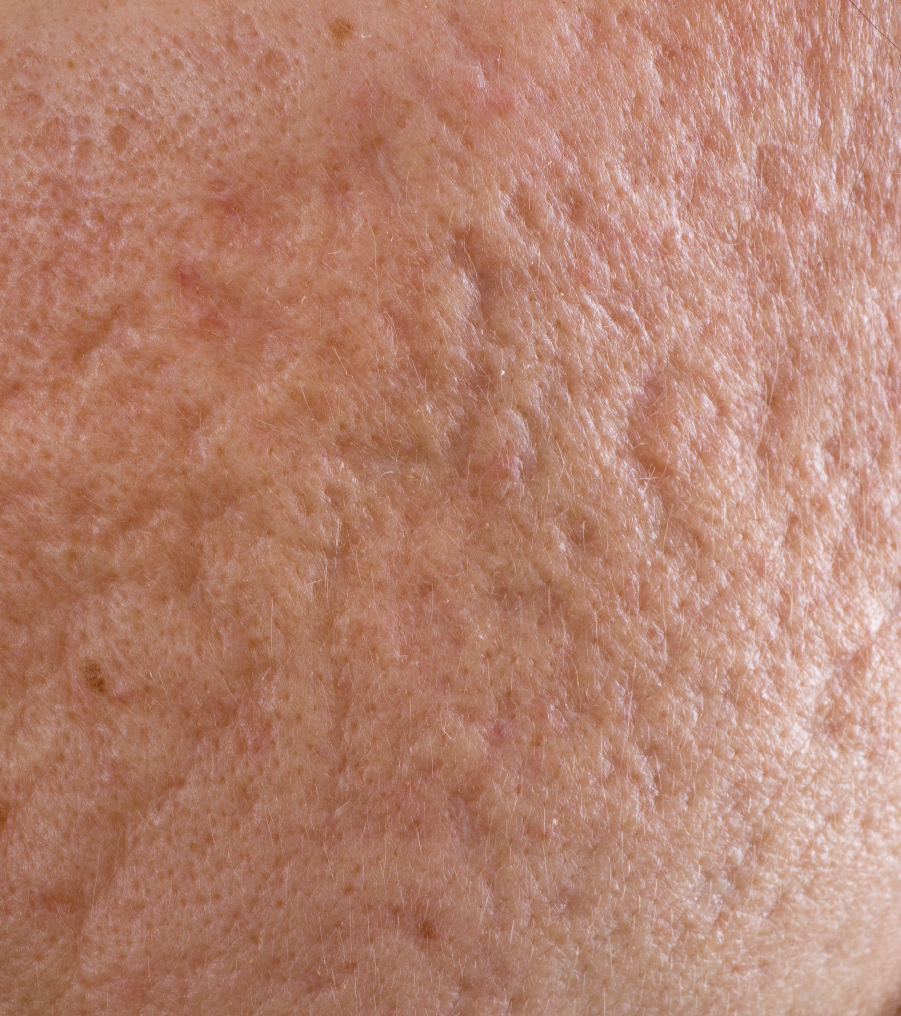 atrofisk ar på kinderne